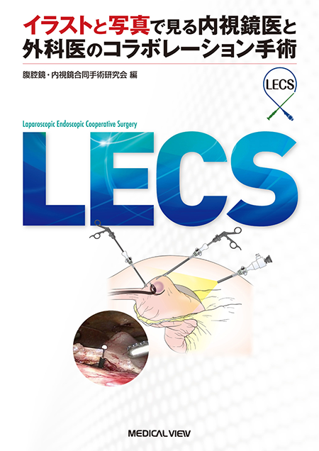 LECS イラストと写真で見る内視鏡医と外科医のコラボレーション手術