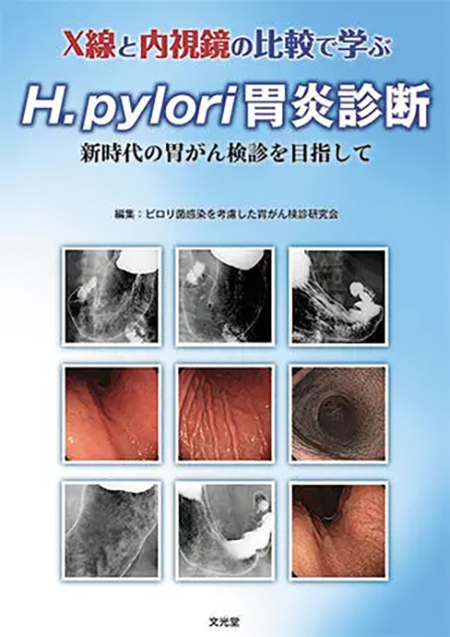 M2PLUS | X線と内視鏡の比較で学ぶH.pylori胃炎診断 ―新時代の胃がん